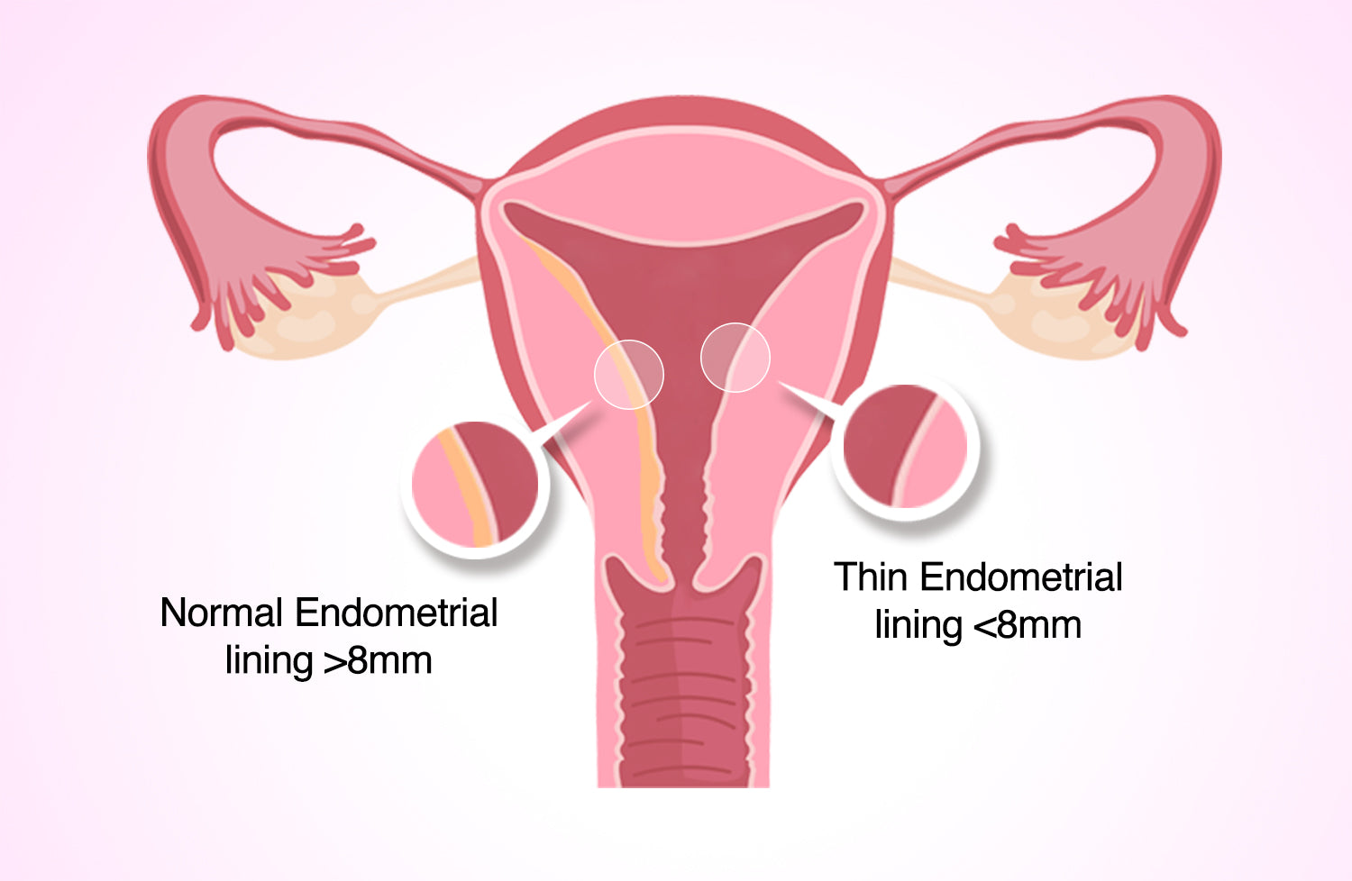 endometrial lining with IUD