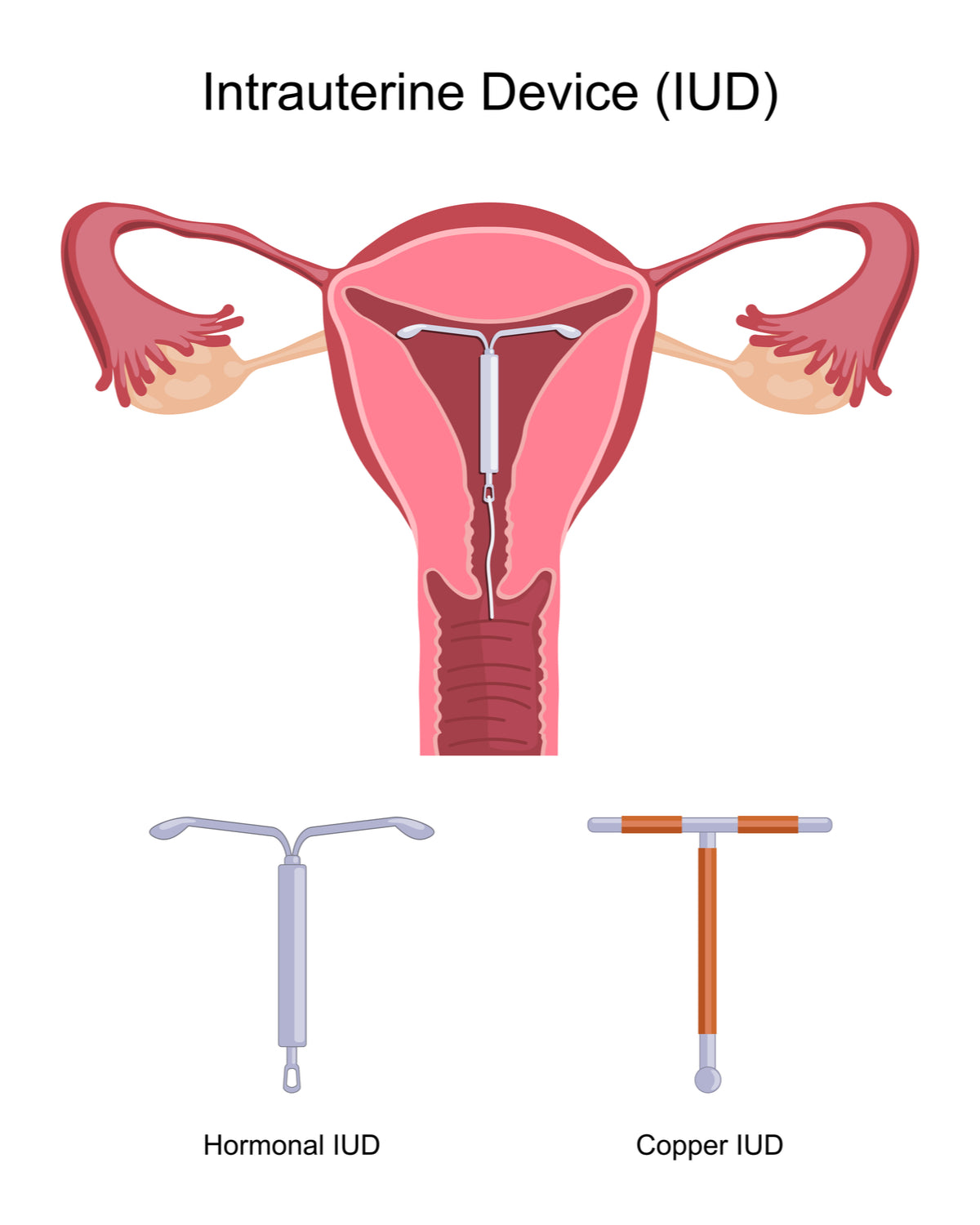 Hormonal vs Copper IUD