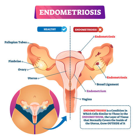 Endometriosis: Symptoms