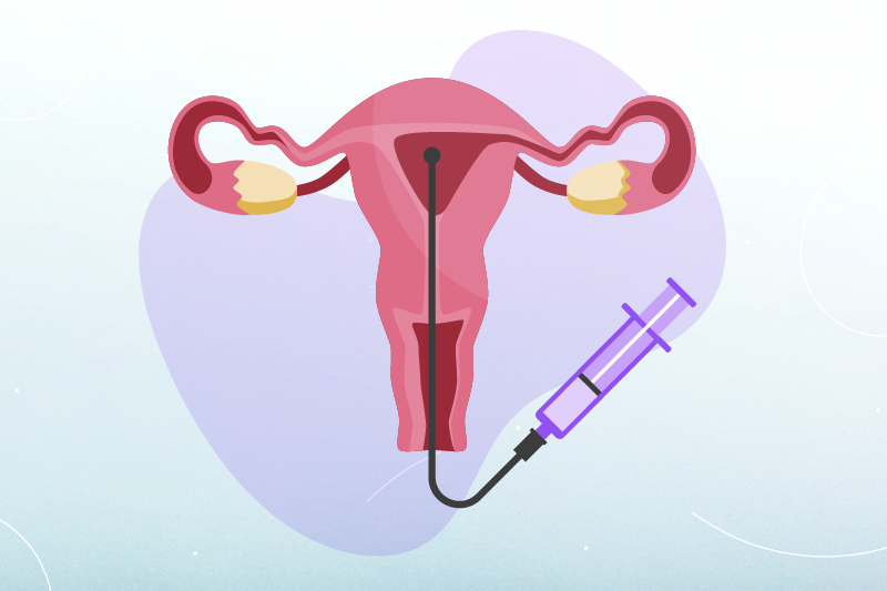 intrauterine insemination process
